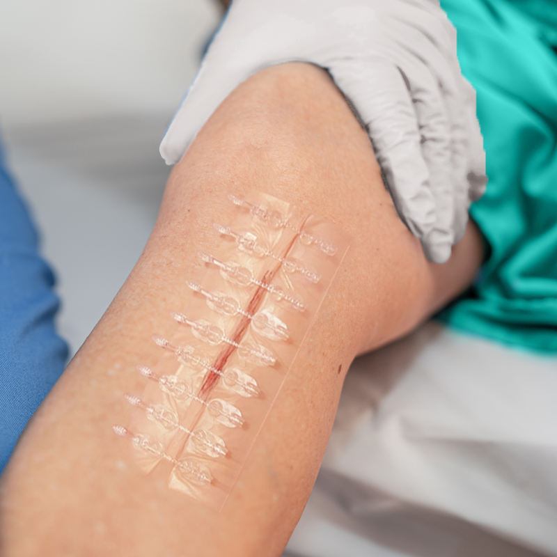 Conkote® ConkoZip-Surgical Incision Closure Set 8cm