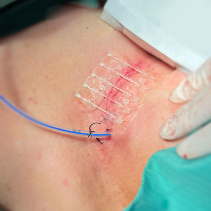 Conkote® ConkoZip-Surgical Incision Closure Set 8cm